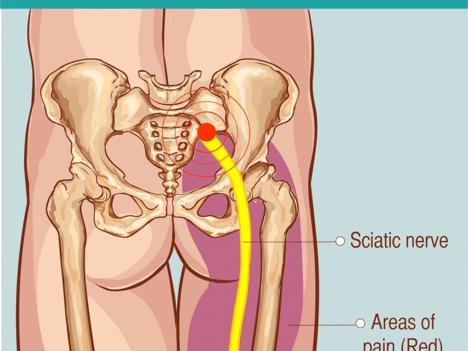 acupuncture coquitlam sciatic nerve treatment