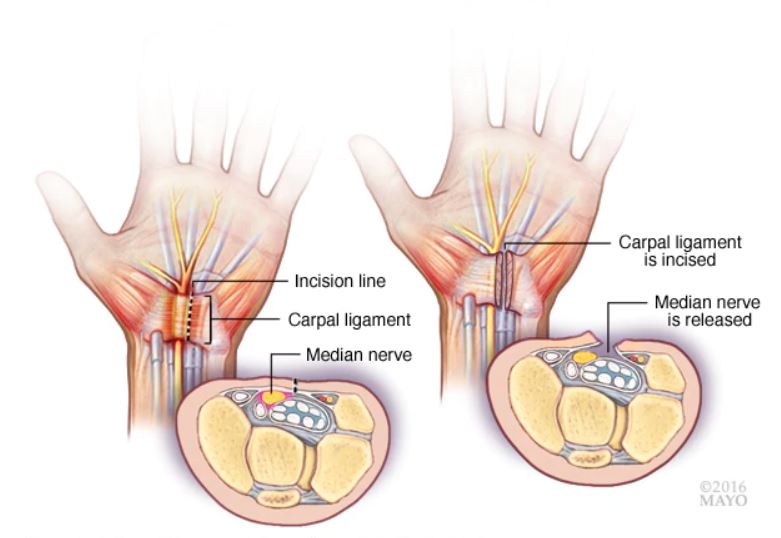 Chiropractic Treatment for Carpal Tunnel Syndrome - Vale Health Clinic