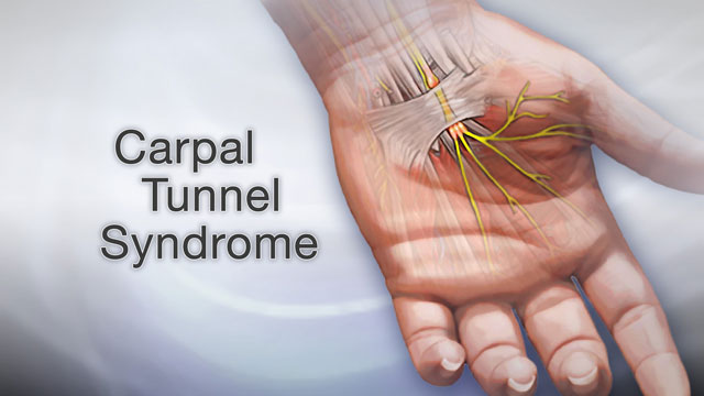 3 Treatments for Carpal Tunnel Syndrome and how Chiropractors can help.